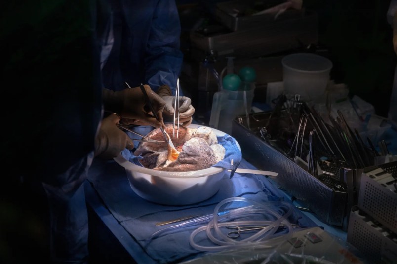 The first double lung transplant using a robot…an innovative procedure that brings new hope